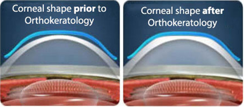 佩戴角膜塑形镜眼表前后对比