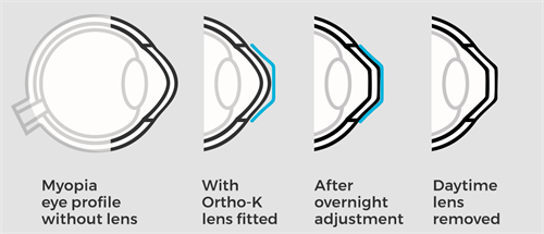 角膜塑形镜改善眼表