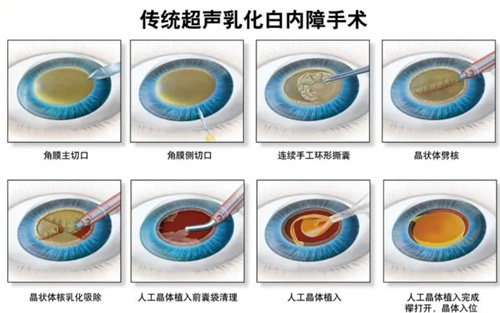 超声白内障手术动画图