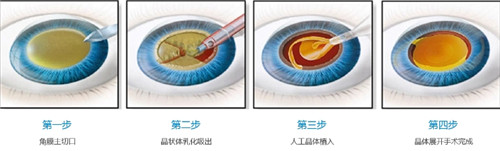 白内障手术步骤图