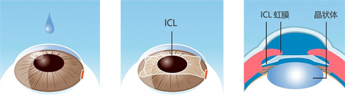 晶体植入手术过程图
