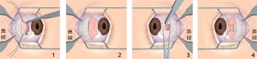 斜视手术过程图