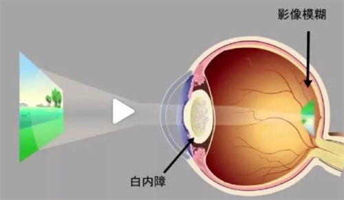 白内障的眼球