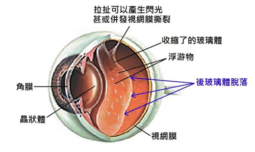 视网膜脱落的眼底