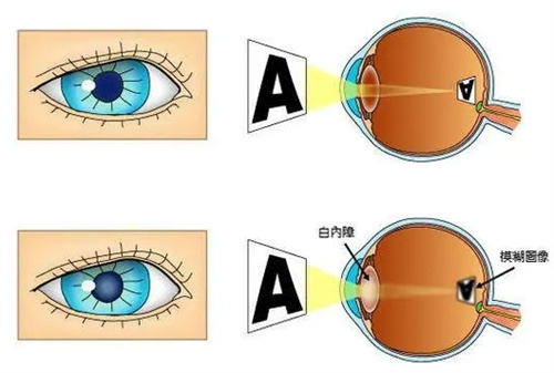 正常眼和白内障对比图