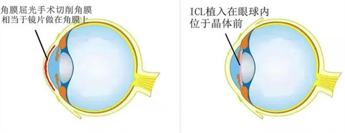 ICL晶体植入和角膜曲光手术
