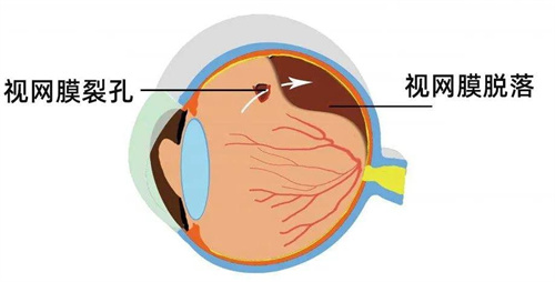 视网膜脱落动画图