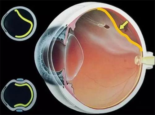 视网膜脱落结构图