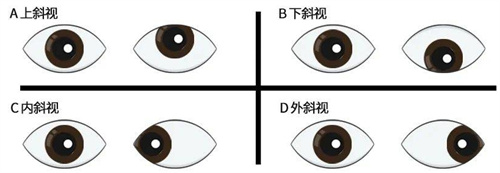 四种不同斜视对比图