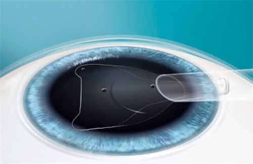 ”icl手术后眼睛失明了“”icl可逆但伤害更大“说法真的吗?