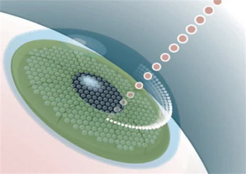 飞秒激光近视手术过程图解