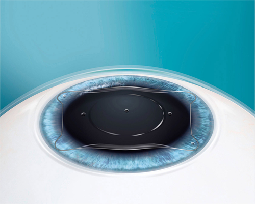 晶体植入眼睛手术后40岁必瞎是真的吗?做了icl能揉眼睛吗?