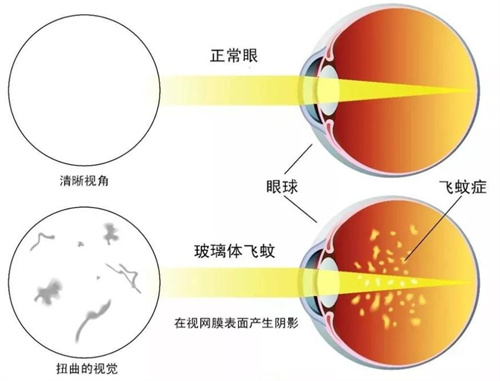 飞蚊症