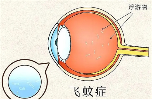 飞蚊症图