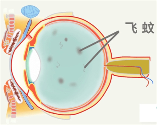 飞蚊症图片