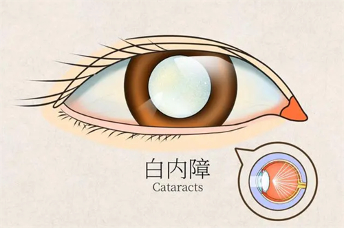 淄博白内障免费政策落实,想申请免费手术需要具备哪些条件?