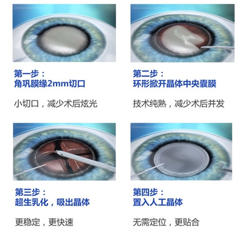 ​晶体置换手术为什么不建议年轻人做，来看看具体的原因