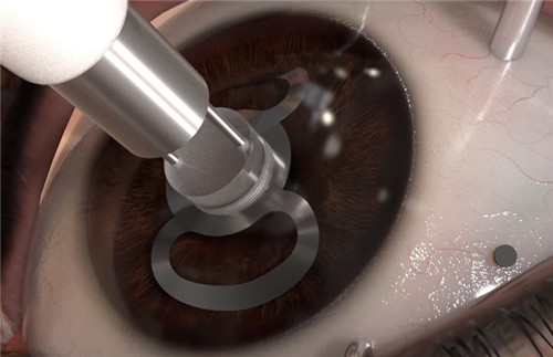 角膜移植手术模拟图
