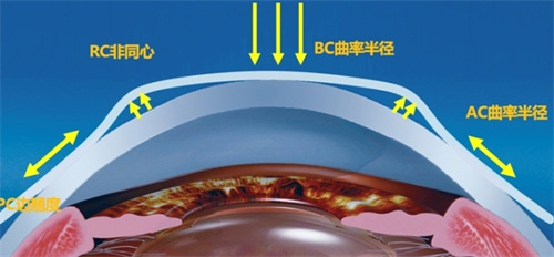 普诺瞳角膜塑形镜原理展示