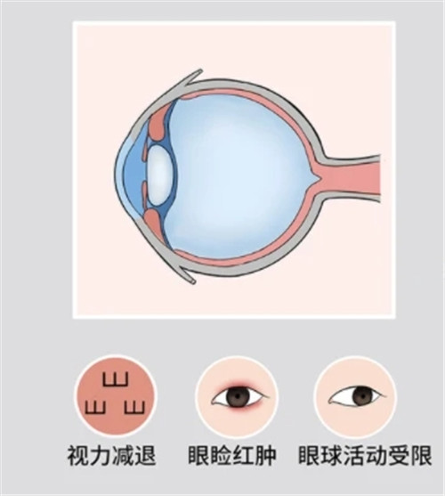 近视500度眼球会突出吗？眼轴拉长后做近视手术还有用吗？