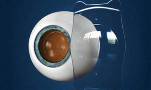 圆锥角膜可以做icl晶体植入术吗?术后视力恢复情况如何?