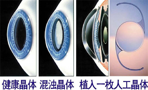 白内障晶体植入近视手术后角膜的变化图解