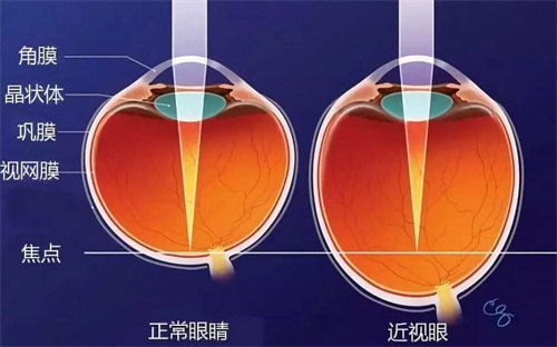 正常眼睛和近视眼对比图