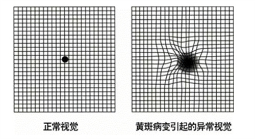 黄斑病变和正常视觉对比图