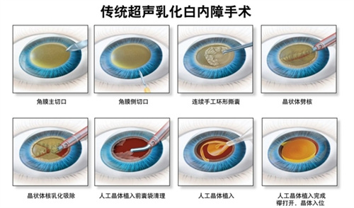 超声乳化白内障手术过程图