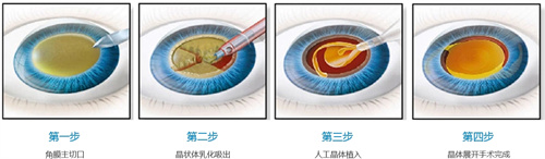 白内障手术过程图