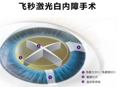 飞秒激光治疗白内障费用是多少？2w+并发症更少！