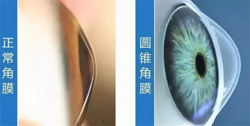 正常角膜和圆锥角膜角膜对比图