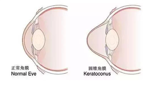 圆锥角膜交联术后视力能提升吗，答案是不能直接恢复视力