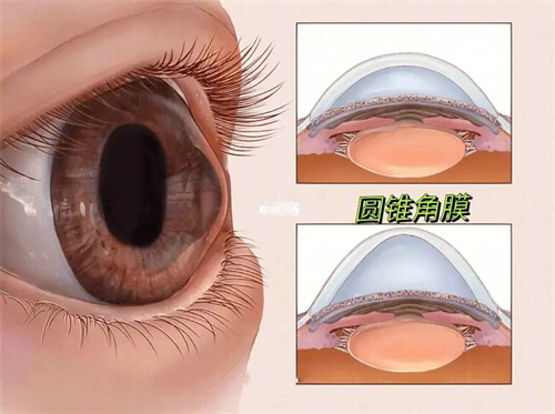 圆锥角膜图片