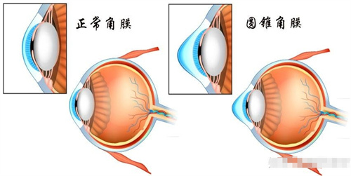 正常角膜与圆锥角膜对比图