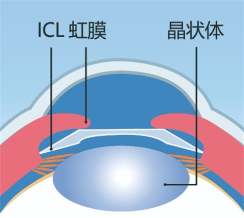 ICL晶体植入手术后遗症和风险分享，大家可以了解一下!