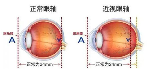 小朋友眼轴超过24就会近视吗 近视参照点并非只有眼轴长度