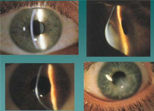 圆锥角膜做了手术能恢复视力吗？做圆锥角膜手术风险大吗