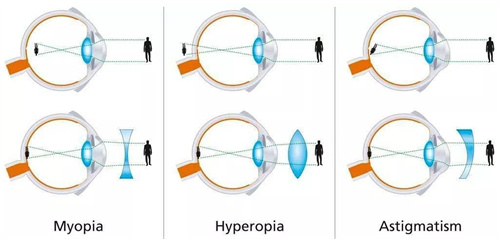 近视眼和正常眼对比图