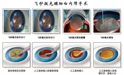 飞秒激光白内障手术动画