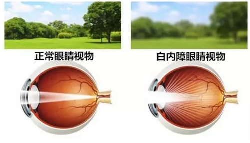 正常视光与白内障视光对比