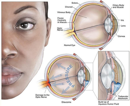 青光眼眼睛内部情况