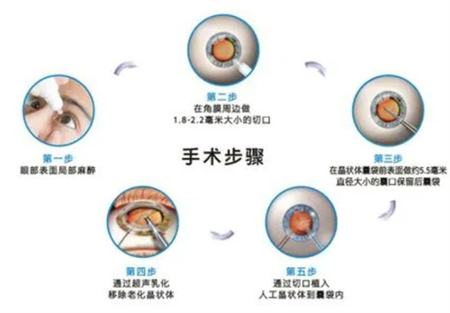 糖尿病白内障晶体如何选择？非球面折叠晶体更适合！