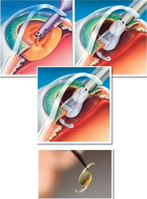 手术中放置人工晶体