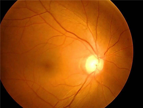 科普青光眼早期五大征兆和表现，及时治疗能避免许多问题