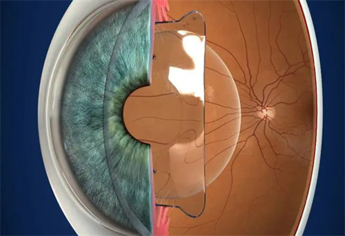 ticl晶体植入手术价格：28000元起，不贵还不伤角膜