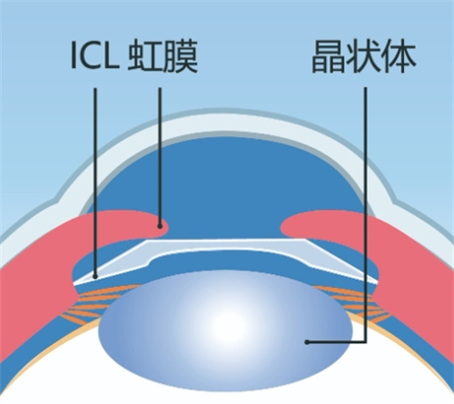 ICL晶体植入手术图片 