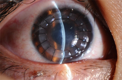圆锥角膜是玩手机害的吗？圆锥角膜还能恢复视力吗？