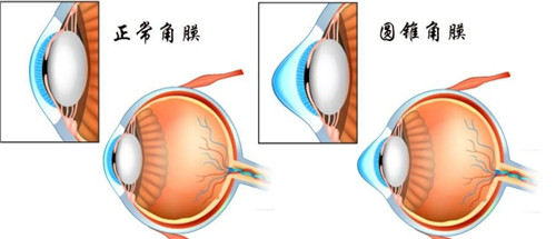 正常角膜和圆锥角膜的不同