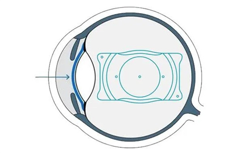 近视手术晶体植入价格一览表：基础1.4w/散光1.6w元起